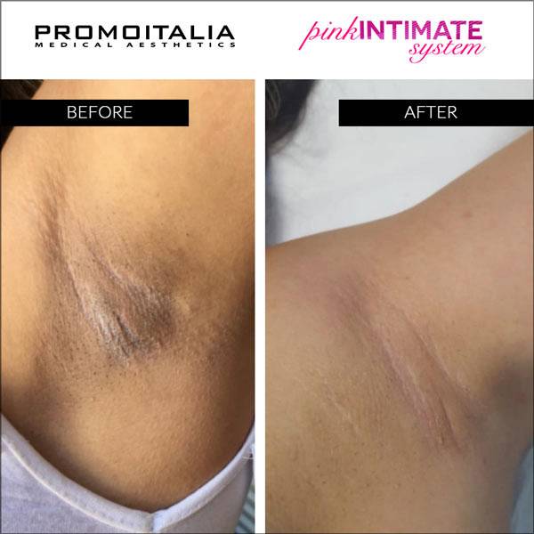 Promoitalia Pink Intimate System